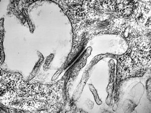 F,23y. | desmosome - normal oral mucosa F,23y. | desmosome - normal oral mucosa